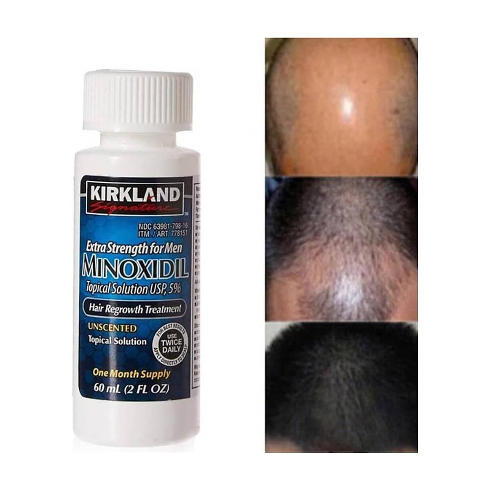 Minoxidil 5% Soluci&oacute;n T&oacute;pica Tratamiento Regenerativo 1 Und image number 2.0