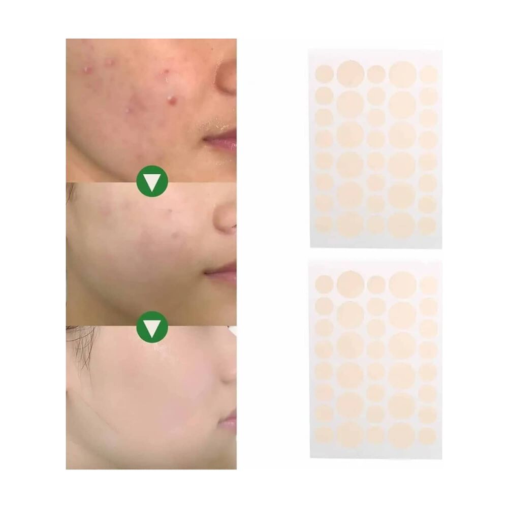Parches Anti - Acn&eacute; Ultra Delgados image number 0.0