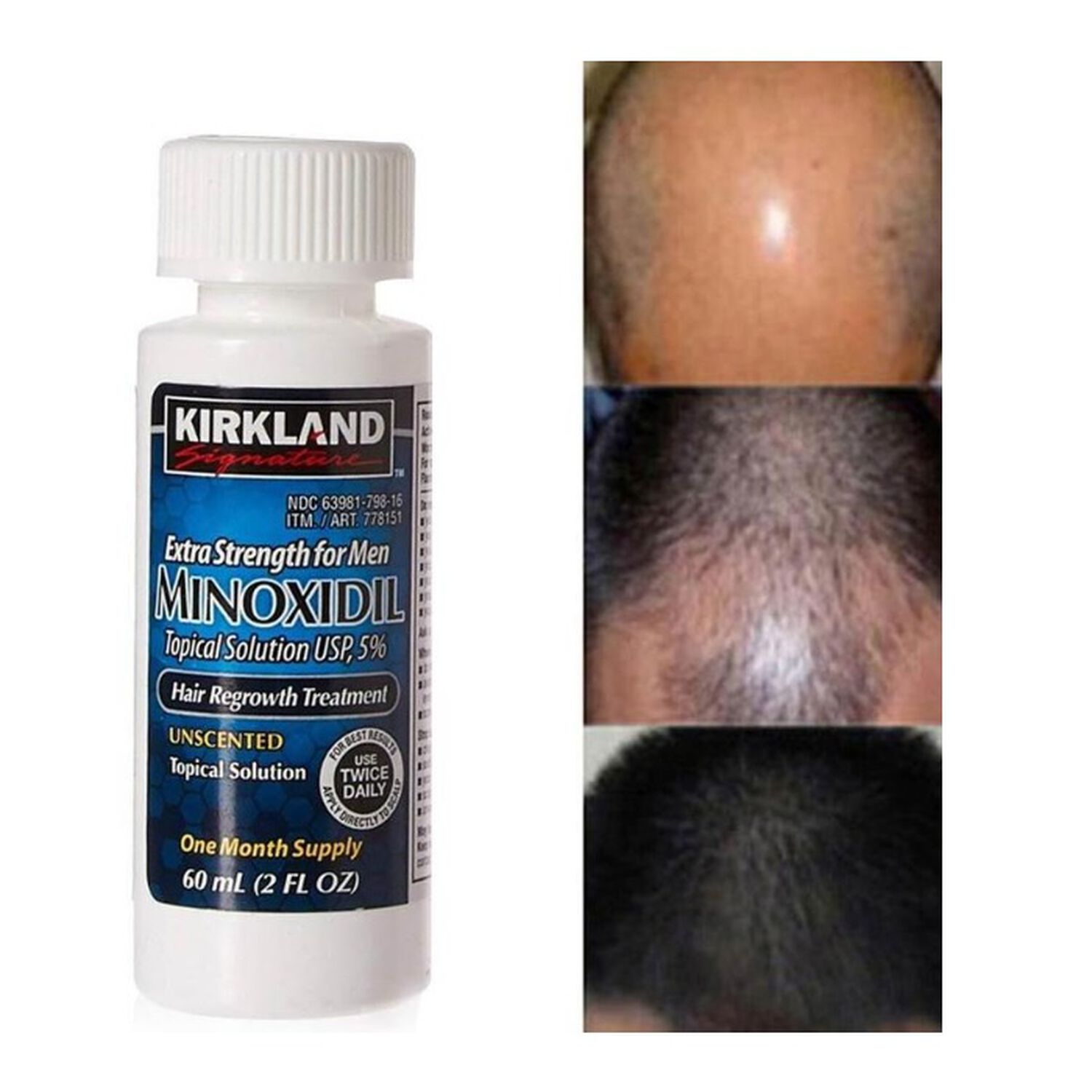 Minoxidil 5% Soluci&oacute;n T&oacute;pica Tratamiento Regenerativo 1 Und image number 2.0